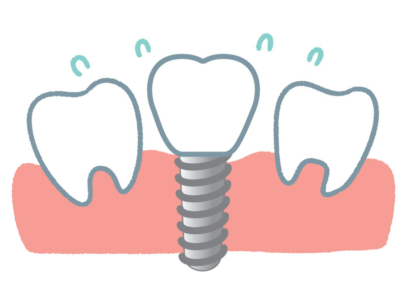 インプラント